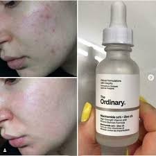 The Ordinary Niacinamide 10% + Zinc 1 % - 20 ml - Image 5